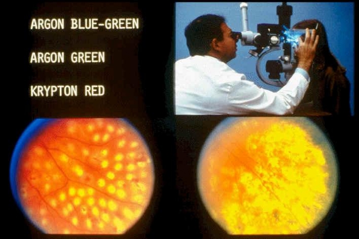 immagine 1 di Le Complicanze Oculari nel Diabete Mellito , la retinopatia diabetica