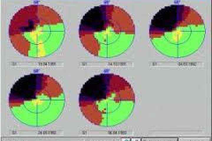 immagine 3 di Il Glaucoma, sintomi e terapia