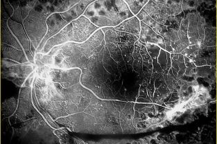 immagine 6 di Le Complicanze Oculari nel Diabete Mellito , la retinopatia diabetica