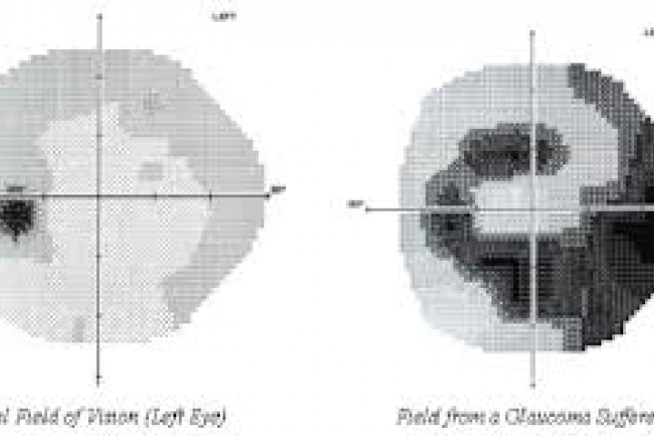 immagine 7 di Campo Visivo Perimetria Computerizzata glaucoma e patologie retiniche e neurologiche