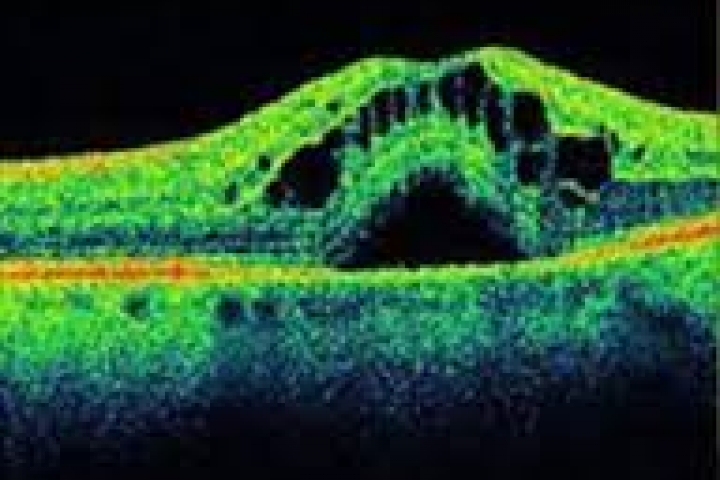 immagine 2 di OCT Tomografia a Coerenza Ottica studio della retina