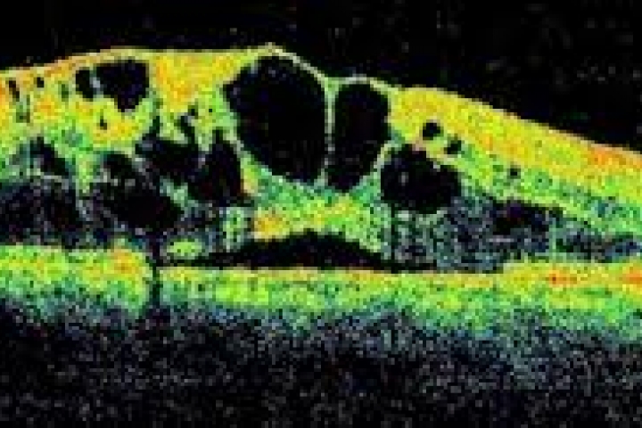 immagine 3 di OCT Tomografia a Coerenza Ottica studio della retina