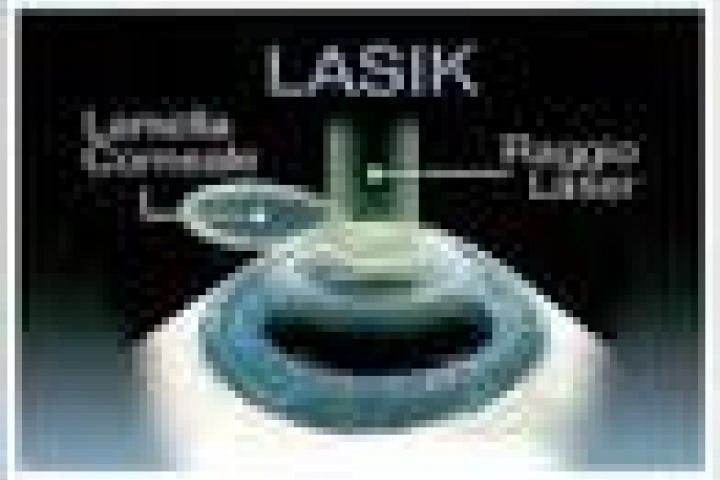 immagine 3 di Trattamento fotorefrattivo con Laser ad Eccimeri PRK Femto LASIK