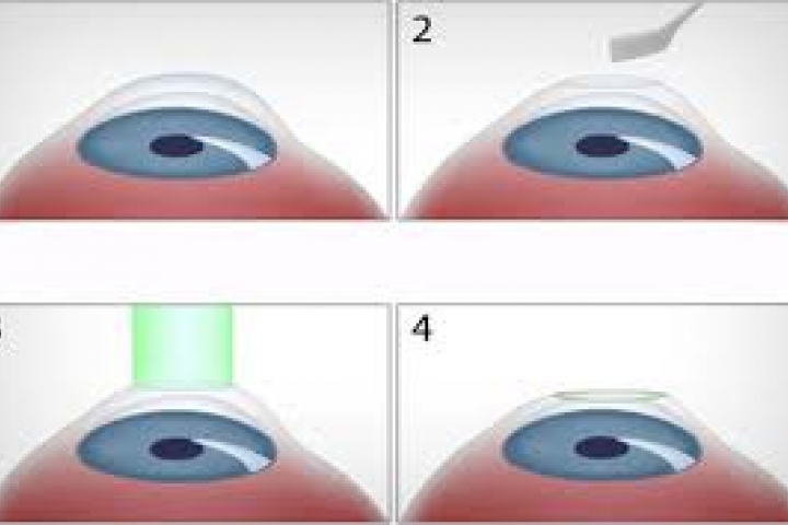 immagine 7 di Trattamento fotorefrattivo con Laser ad Eccimeri PRK Femto LASIK