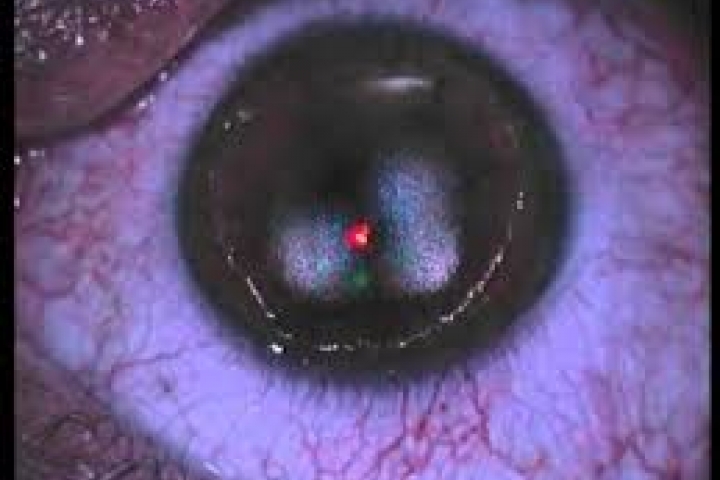 immagine 4 di Trattamento fotorefrattivo con Laser ad Eccimeri PRK Femto LASIK