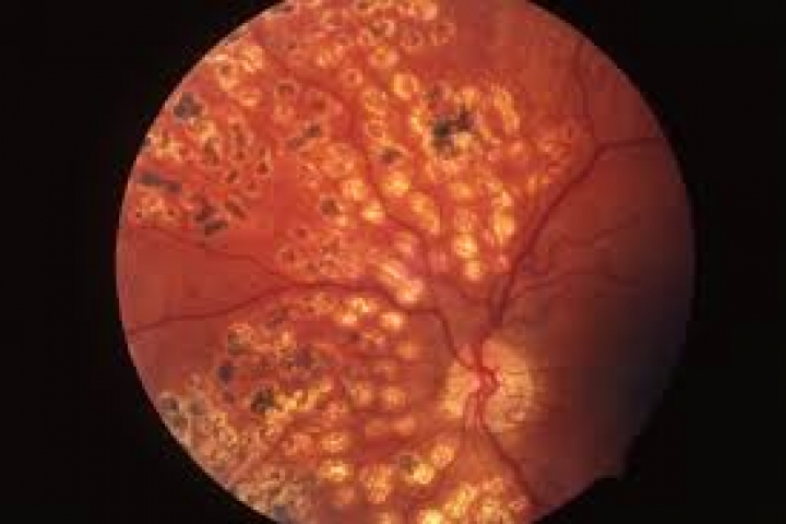 immagine 5 di Trattamento retinico con Laser (retinopatia diabetica, fori retinici, lacerazioni)