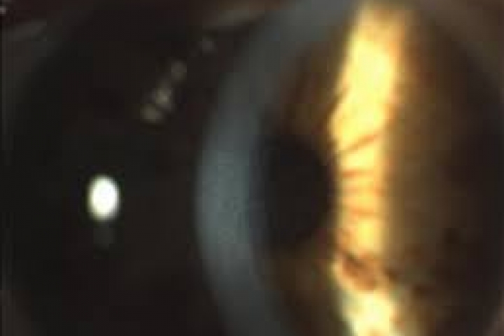 immagine 3 di Biomicroscopia Endoteliale Pachimetria studio della cornea