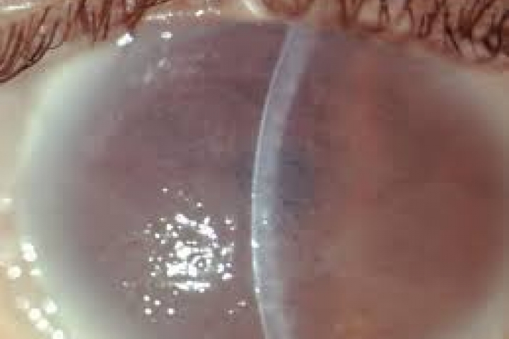 immagine 8 di Biomicroscopia Endoteliale Pachimetria studio della cornea