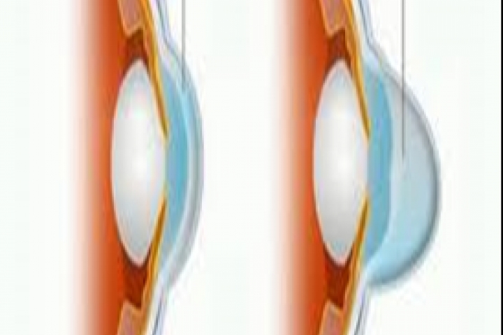 immagine 2 di Cross Linking Stimolatore UV per la cura del Cheratocono con Iontoforesi