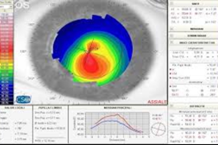 immagine 4 di Topografia Corneale, studio della cornea, mappatura corneale e cheratocono