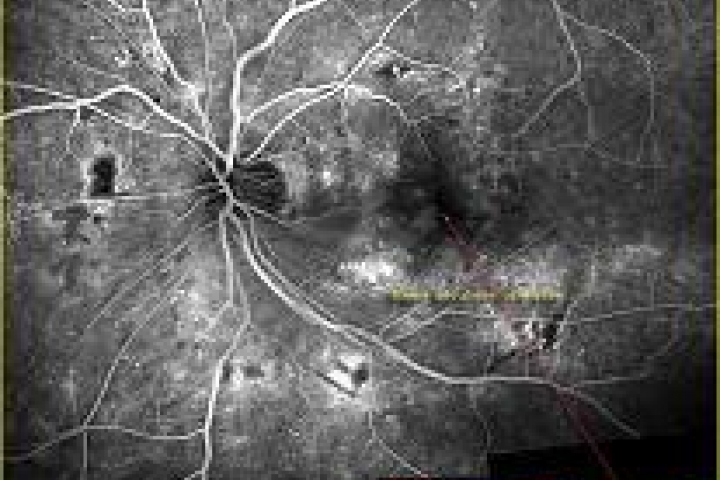 immagine 5 di Le Complicanze Oculari nel Diabete Mellito , la retinopatia diabetica