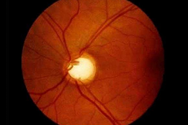 immagine 2 di Il Glaucoma, sintomi e terapia