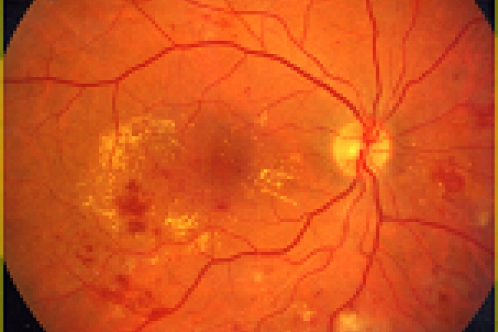 immagine 2 di Le Complicanze Oculari nel Diabete Mellito , la retinopatia diabetica