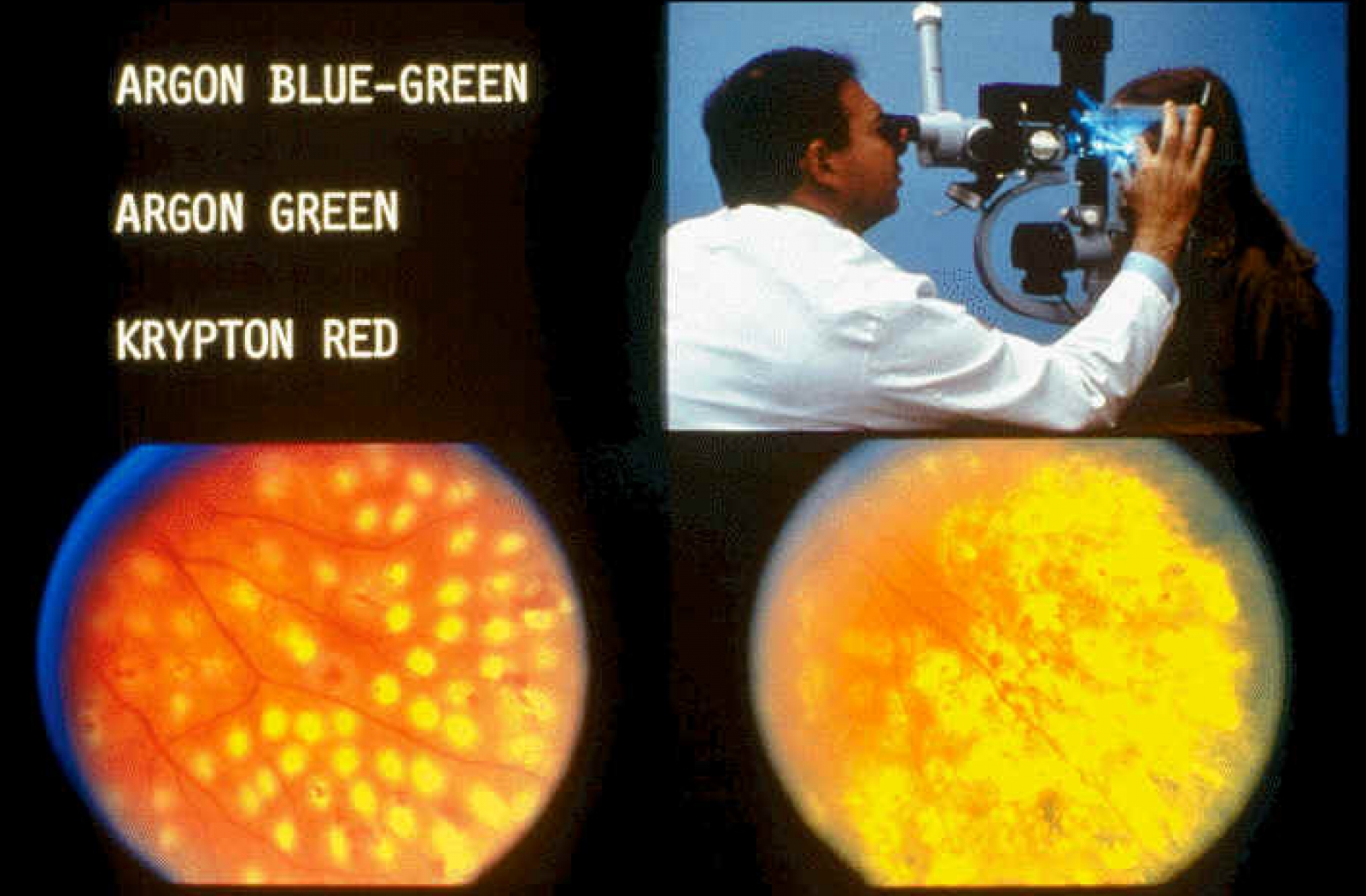 Trattamento retinico con Laser (retinopatia diabetica, fori retinici, lacerazioni)
