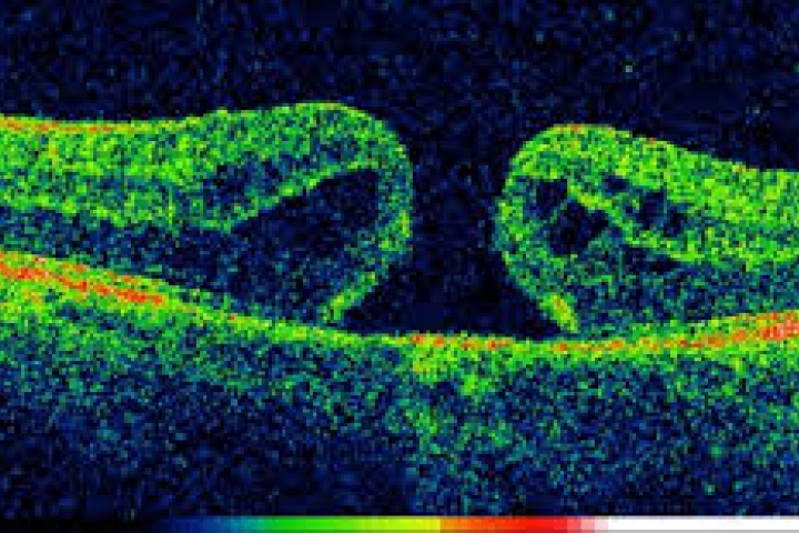 immagine 4 di OCT Tomografia a Coerenza Ottica studio della retina