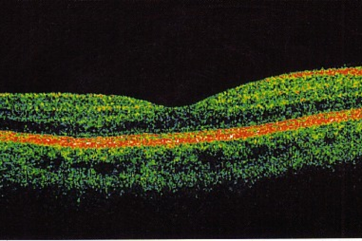 immagine 5 di OCT Tomografia a Coerenza Ottica studio della retina