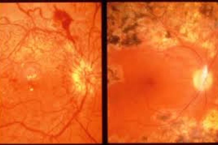 immagine 4 di Trattamento retinico con Laser (retinopatia diabetica, fori retinici, lacerazioni)