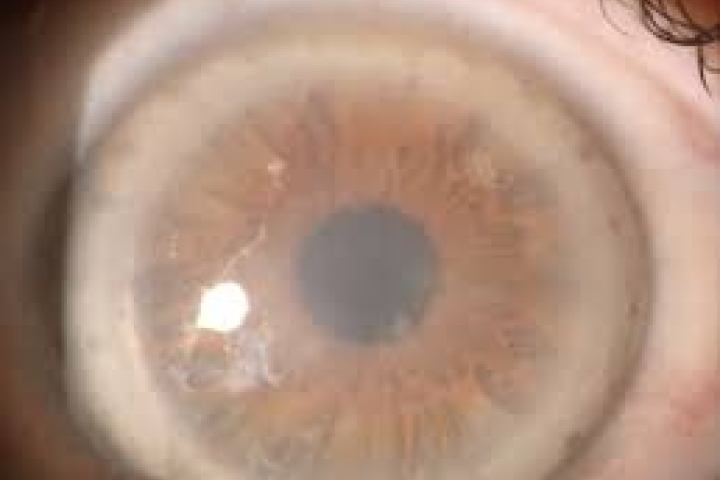 immagine 2 di Biomicroscopia Endoteliale Pachimetria studio della cornea